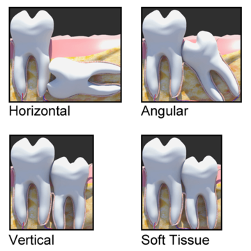 Wisdom Tooth Positions