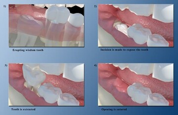 Wisdom Tooth Removal